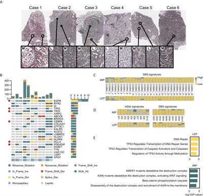 Comprehensive analyses unveil novel genomic and immunological characteristics of micropapillary pattern in lung adenocarcinoma